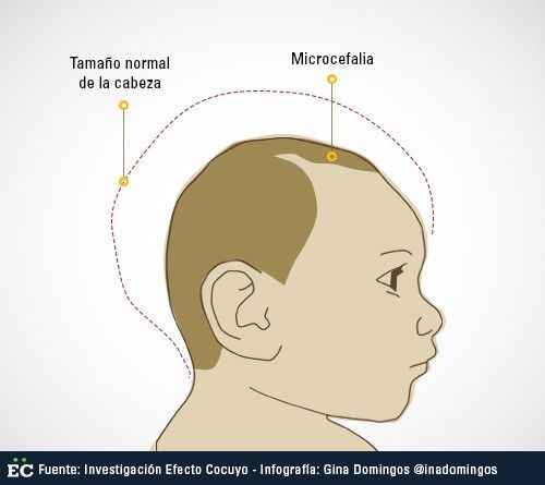 microcefalia