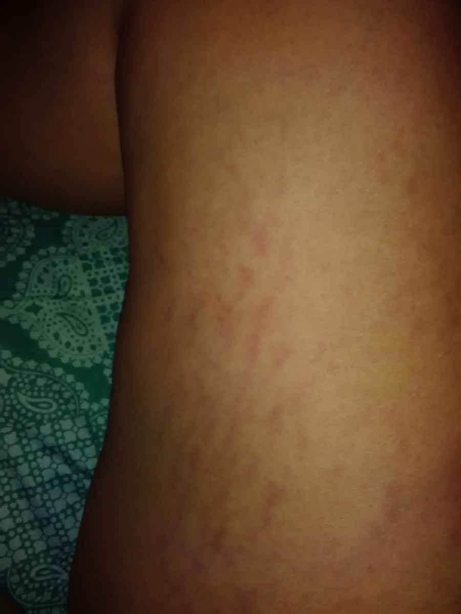 Pierna de niño con vasculitis, inflamación de los vasos sanguíneos