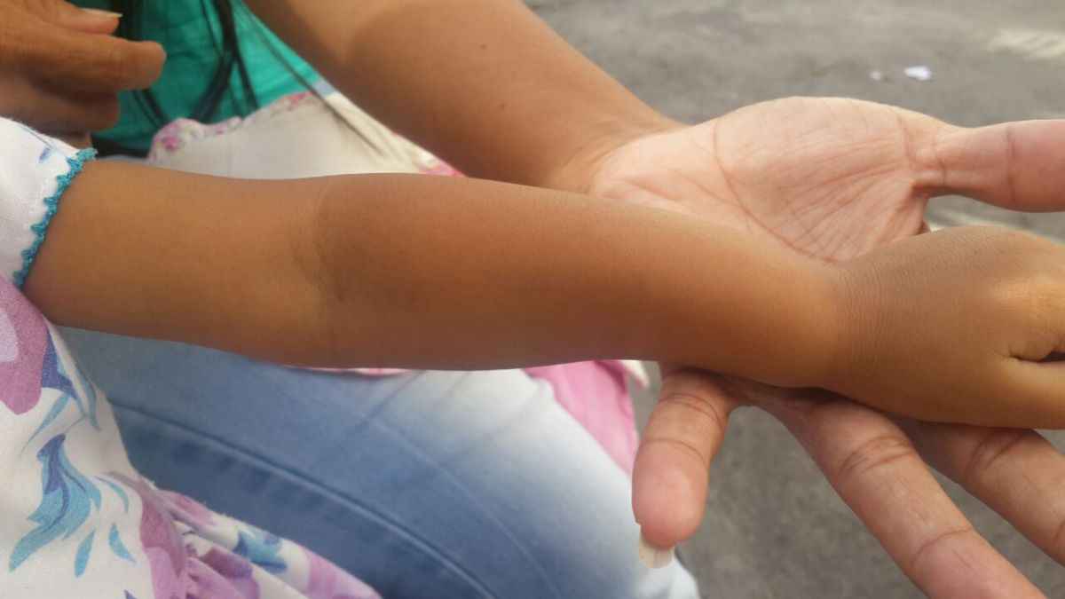 Brazo de Karla sin su medicamento