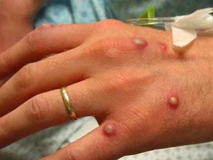 OMS ve signos "esperanzadores" de retroceso de viruela del mono en Europa