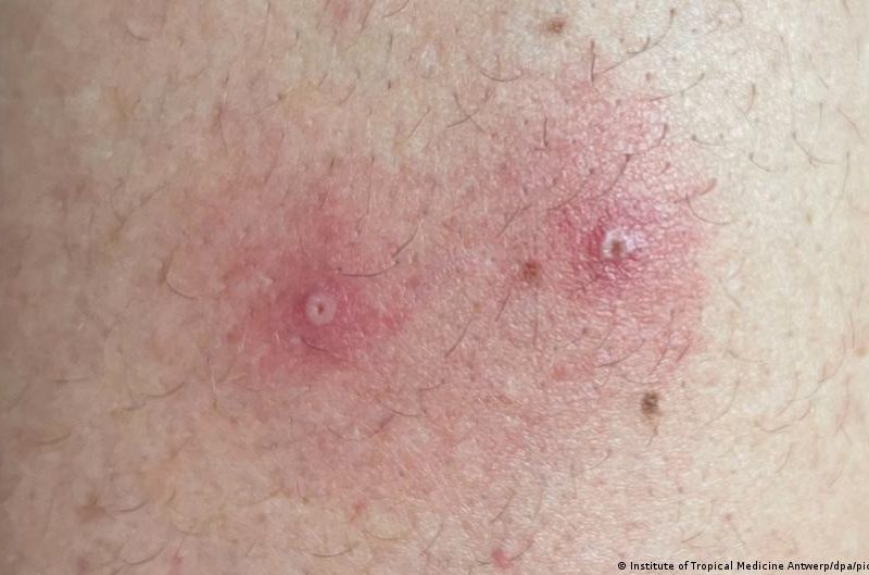 Casos de viruela del mono aumentan un 77 por ciento en una semana