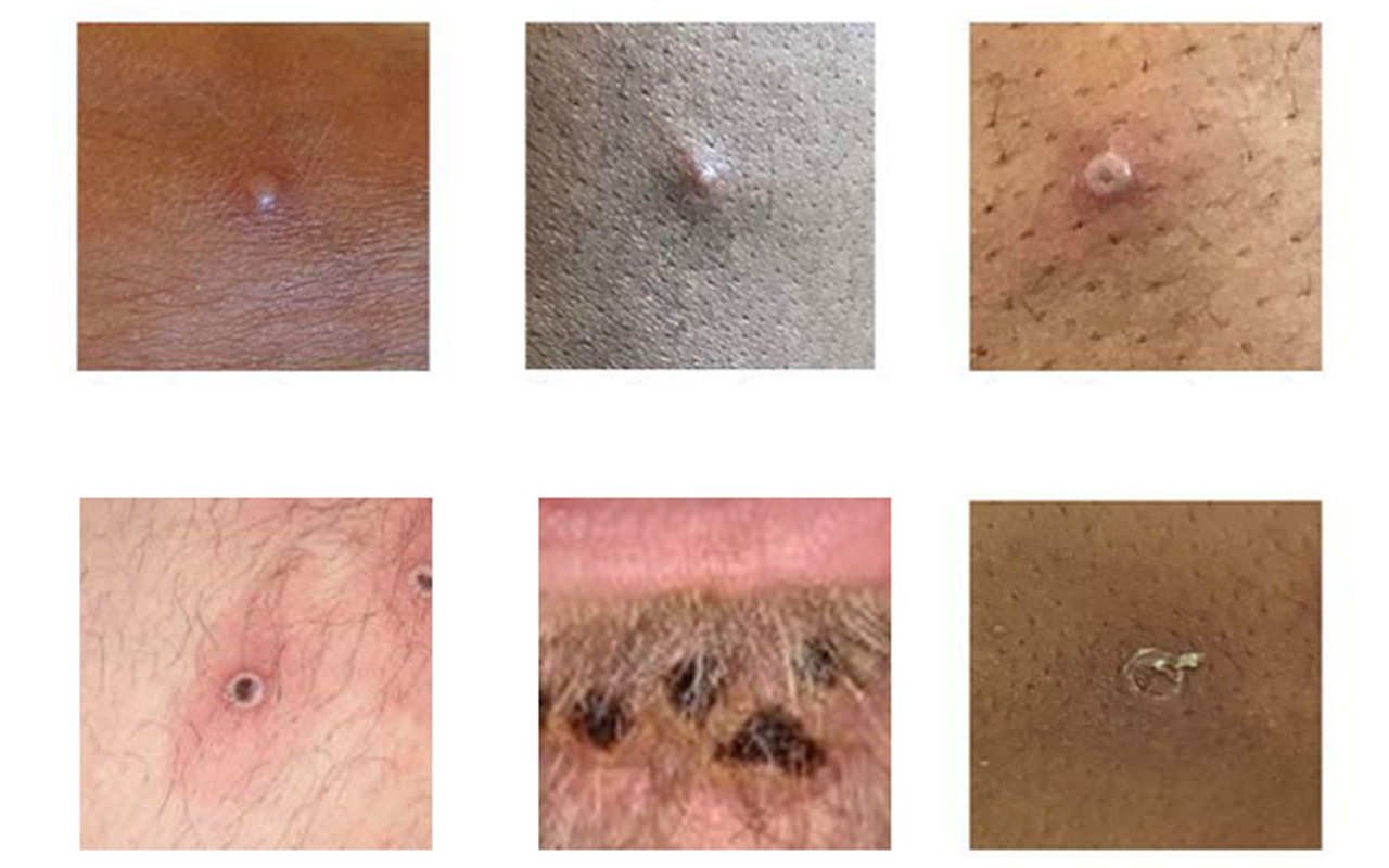 Autoridades sanitarias de EEUU han publicado fotos de las lesiones para orientar a la población | Foto: CDC