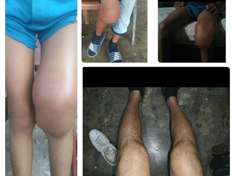 hemofilia en venezuela