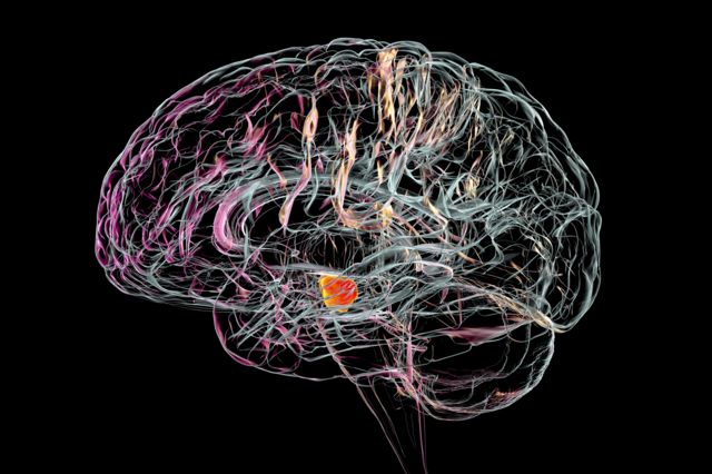 Un cerebro con Párkinson.